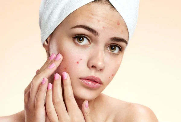 Acne Treatment
