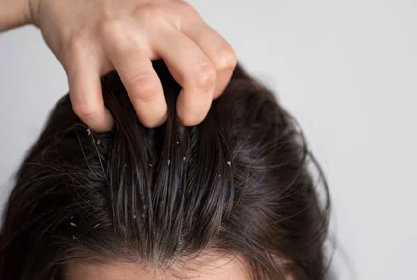 Dandruff Treatment