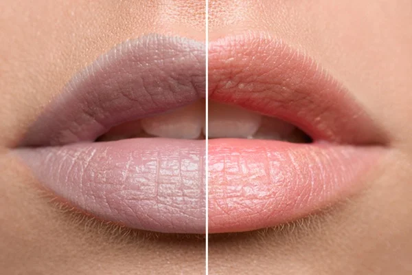 Dark Lips Treatment