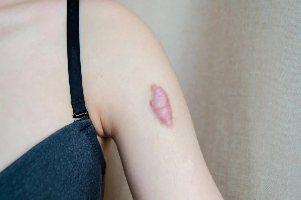 Keloid Treatment